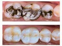 Top: Dental Amalgam filling  Bottom: Composite Resin Filling