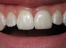 AFTER REPLACEMENT CROWNS