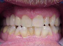 dentures-after