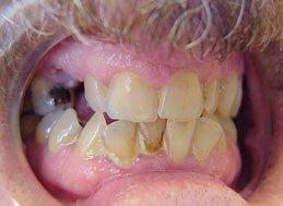 dentures-before