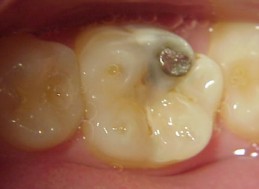 BEFORE - WITH AMALGAM FILLING