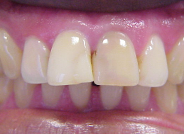 BEFORE veneers