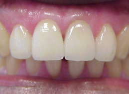 AFTER veneers