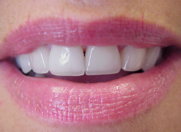 AFTER CROWNS & VENEERS