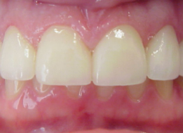 AFTER veneers