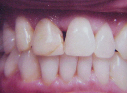 BEFORE veneers