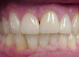 AFTER veneers