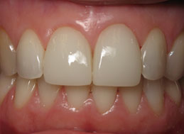 AFTER veneers