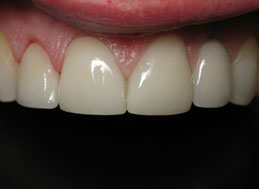 AFTER veneers