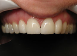 AFTER veneers