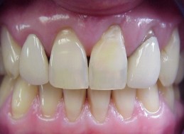 BEFORE REPLACEMENT CROWNS