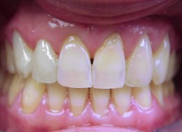 AFTER REPLACEMENT CROWNS