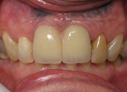 BEFORE REPLACEMENT CROWNS