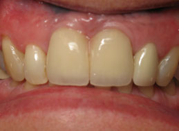 AFTER REPLACEMENT CROWNS