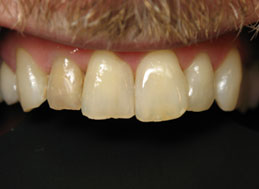 BEFORE REPLACEMENT CROWNS