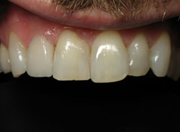 AFTER REPLACEMENT CROWNS