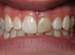 BEFORE REPLACEMENT CROWNS