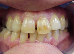 BEFORE REPLACEMENT CROWNS