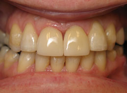 AFTER REPLACEMENT CROWNS