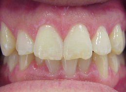 BEFORE WHITENING