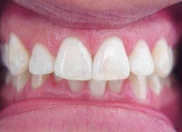 AFTER WHITENING