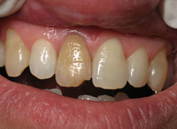 BEFORE WHITENING