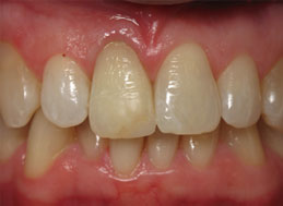 AFTER WHITENING